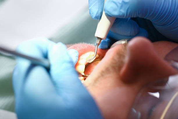 Best Emergency Dental Extractions in Santa Rosa, TX