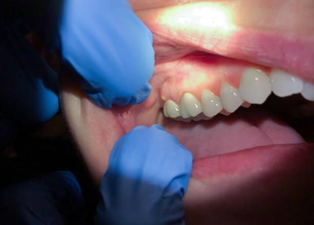 Best Emergency Dentist for Lost Fillings or Crowns in Santa Rosa, TX